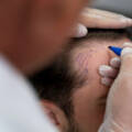 Understanding the Hair Transplant Procedure Step by Step