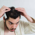 10 Signs You Might Need a Hair Transplant