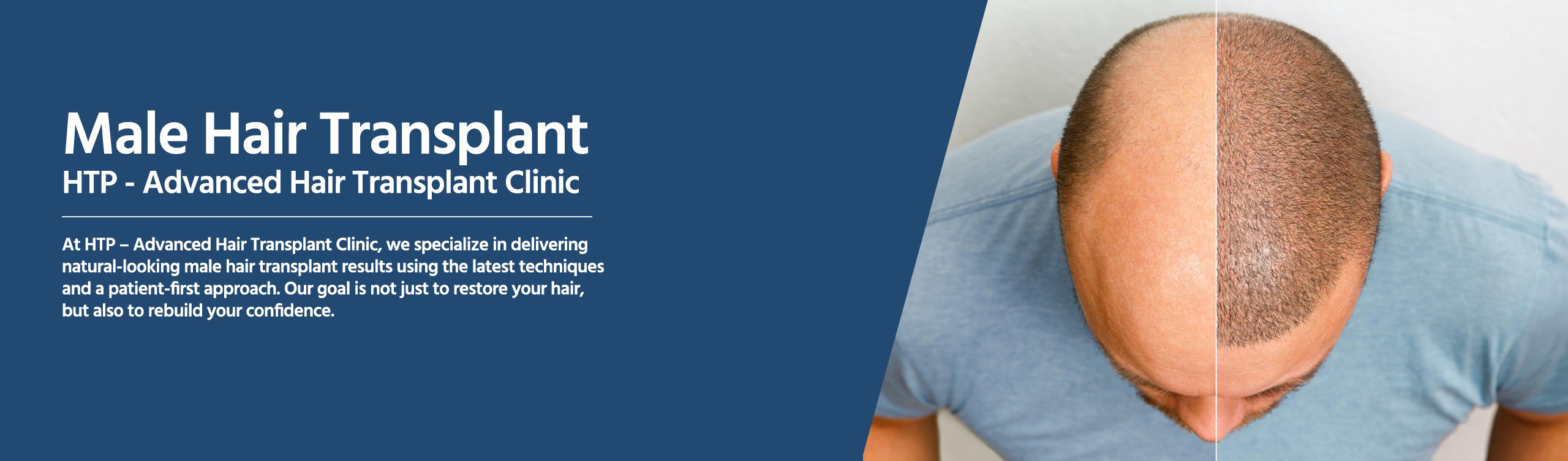 Male Hair Transplant