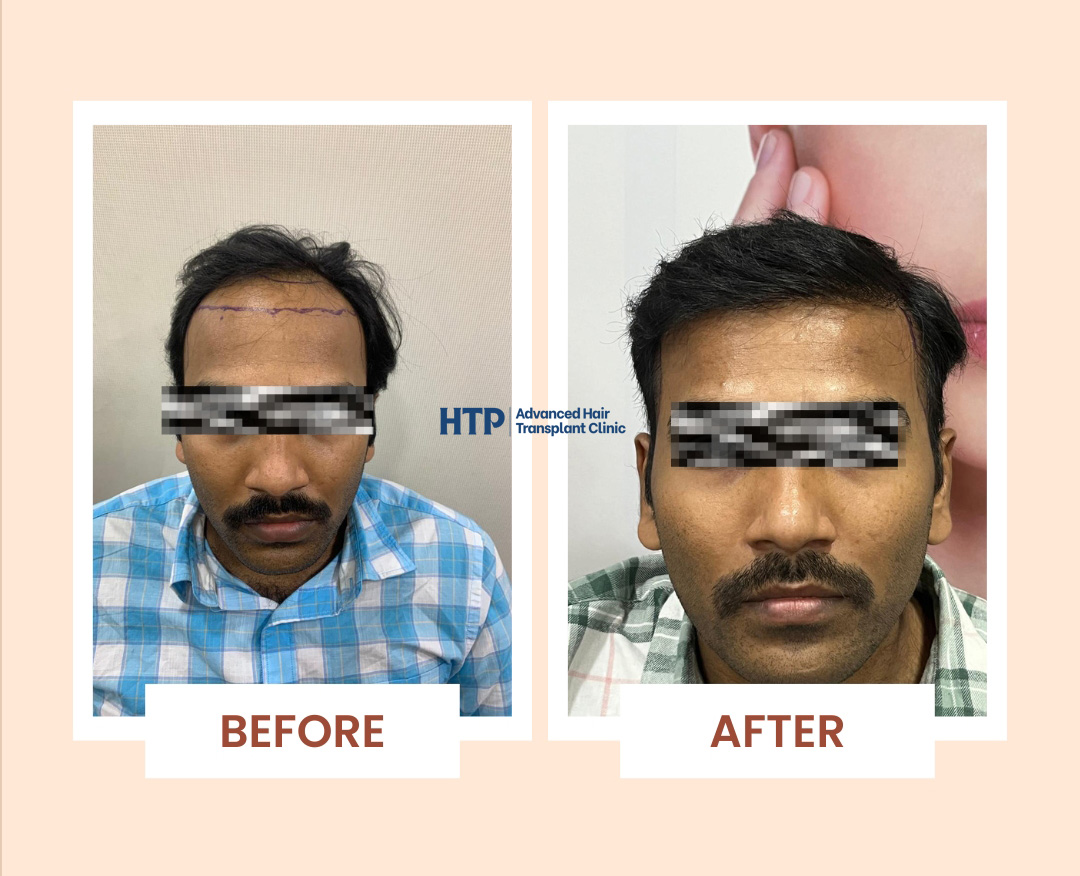 before after 1 with logo