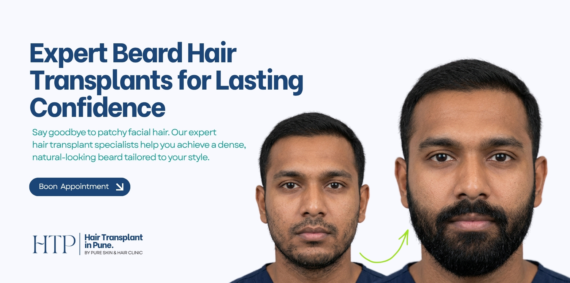 beard hair transplant home